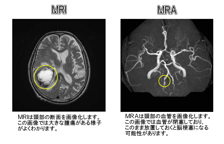 MRI・MRA検査について