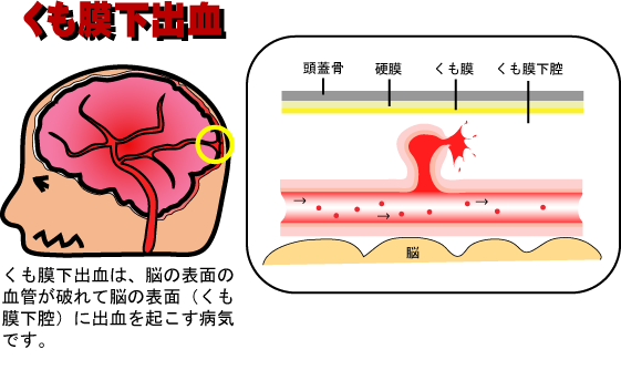 くも膜下出血