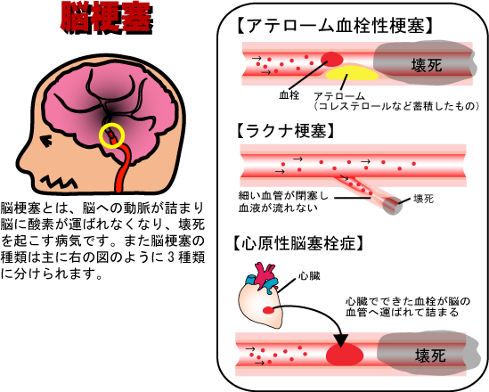 脳梗塞
