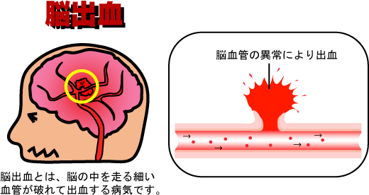 脳出血